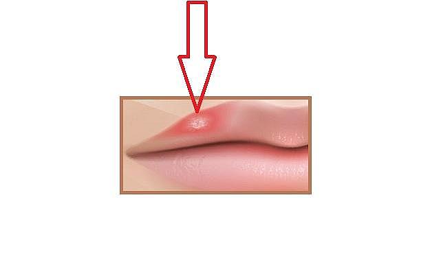 GÜNCEL - Uçuk nedir? Ve ne yapmalı?